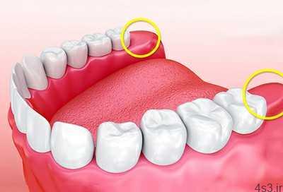 آیا لازم است دندانهای عقل خود را بکشید؟