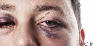 درمان کبودی و ورم چشم در اثر ضربه سایت 4s3.ir