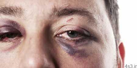 درمان کبودی و ورم چشم در اثر ضربه