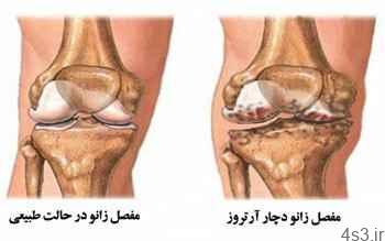 درمان آرتروز زانو با ورزش + تصاویر