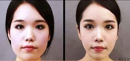 کاهش چربی‌های اضافی صورت
