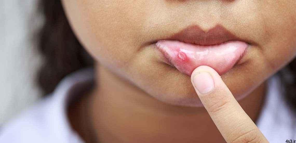 آفت دهان – علل، علائم و راههای پیشگیری از آفت دهان