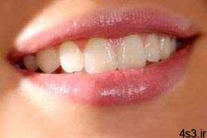 آیا دندان هایتان حالت لقی دارند؟ سایت 4s3.ir