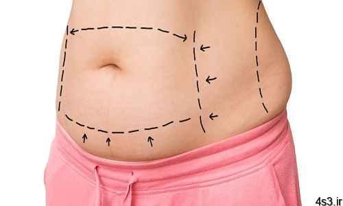 بررسی عوارض جراحی کوچک کردن شکم ابدومینوپلاستی و لیپوماتیک