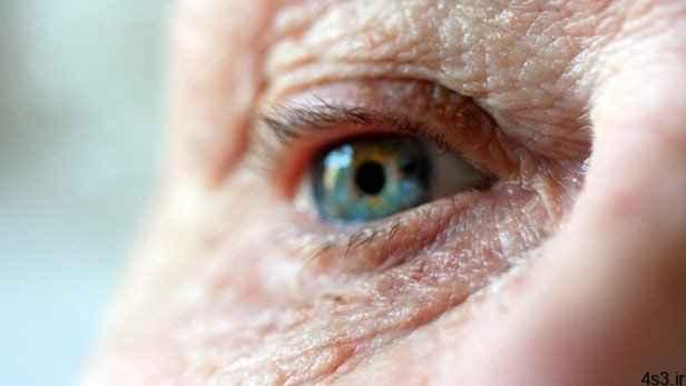 تشخیص آلزایمر با معاینه ساده چشم