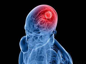 خبرهای پزشکی : تشخیص سریع تومور مغزی با یک روش جدید سایت 4s3.ir