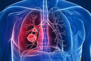 خبرهای پزشکی : تنگی نفس و سرفه اولین علائم سرطان ریه هستند سایت 4s3.ir