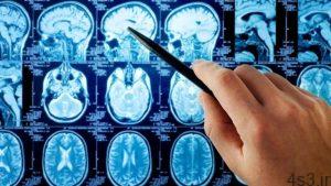 خبرهای پزشکی : درمان موثر و کم هزینه سرطان مغز سایت 4s3.ir