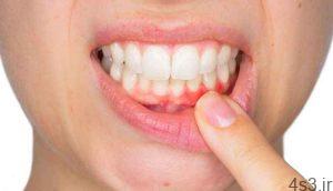 علت ازدست دادن دندان دربزرگسالی سایت 4s3.ir