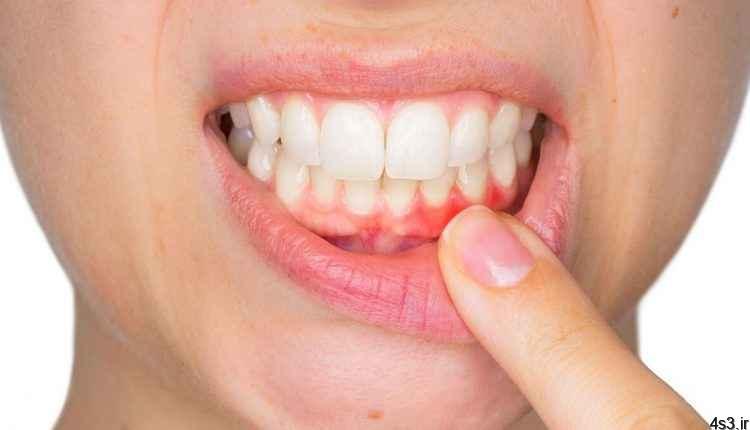 علت ازدست دادن دندان دربزرگسالی