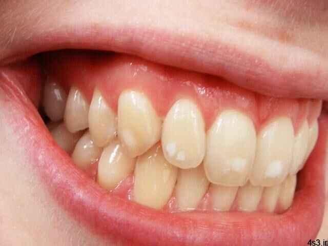 خبرهای پزشکی : فلوراید بیش از حد موجب پوسیدگی مینای دندان می‌شود