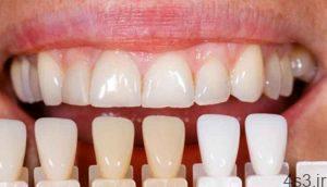 مراحل انجام کار دندانپزشک زیبایی چیست؟ سایت 4s3.ir