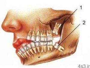 مراقب عوارض دندان عقل باشيد سایت 4s3.ir