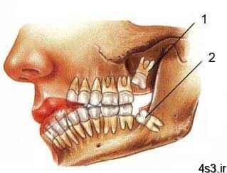 مراقب عوارض دندان عقل باشید