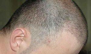 آنچه درباره کاشت مو و روش‌های جایگزین برای درمان ریزش مو باید بدانیم سایت 4s3.ir