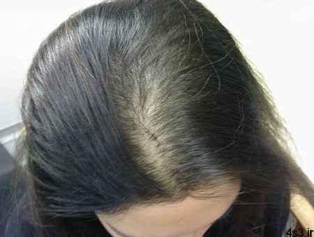 روشهای درمان صحیح ریزش مو