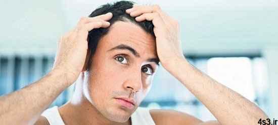 ریزش موی آقایان و راه های جلوگیری از آن