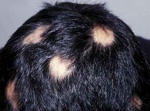 ریزش موی سکه‌ ای از تشخیص تا درمان سایت 4s3.ir