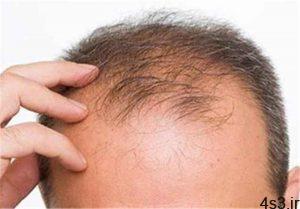5 عامل جهت درمان ریزش مو و پیشگیری از آن سایت 4s3.ir