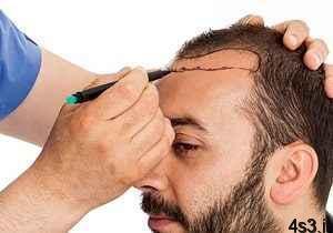 عوارض کاشت موی طبیعی برای بیماران قلبی سایت 4s3.ir