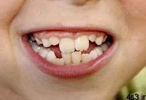 چرا دندان ها کج رشد می کنند؟ سایت 4s3.ir