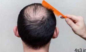 ژنتیک شایع ترین علت ریزش موی سر آقایان سایت 4s3.ir