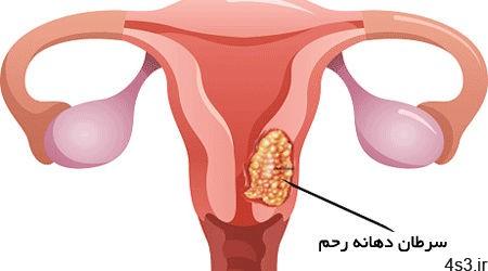 زنگ خطر سرطان های زنانه را بشناسید