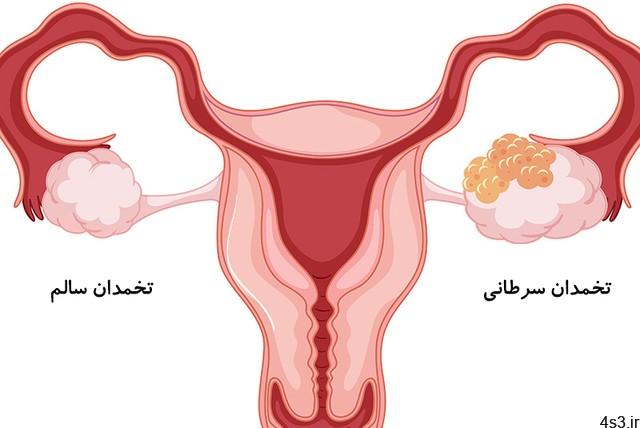 سرطان تخمدان چه علائمی دارد؟