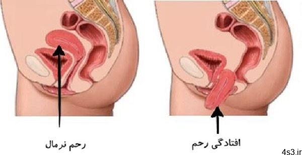 عفونت، شایع ترین عارضه افتادگی رحم