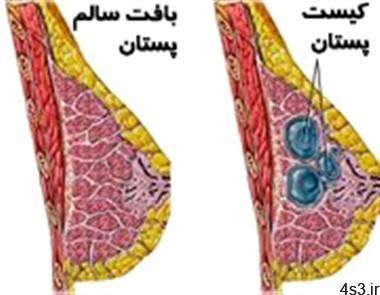 کیست‌ پستان در زنان